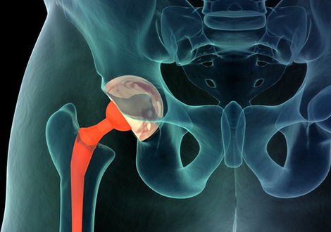 NIOS Structural Repair